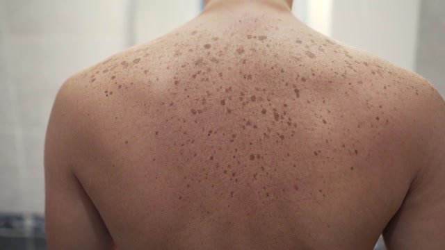 Back Freckles Stock Footage: Royalty-Free Video Clips - Storyblocks