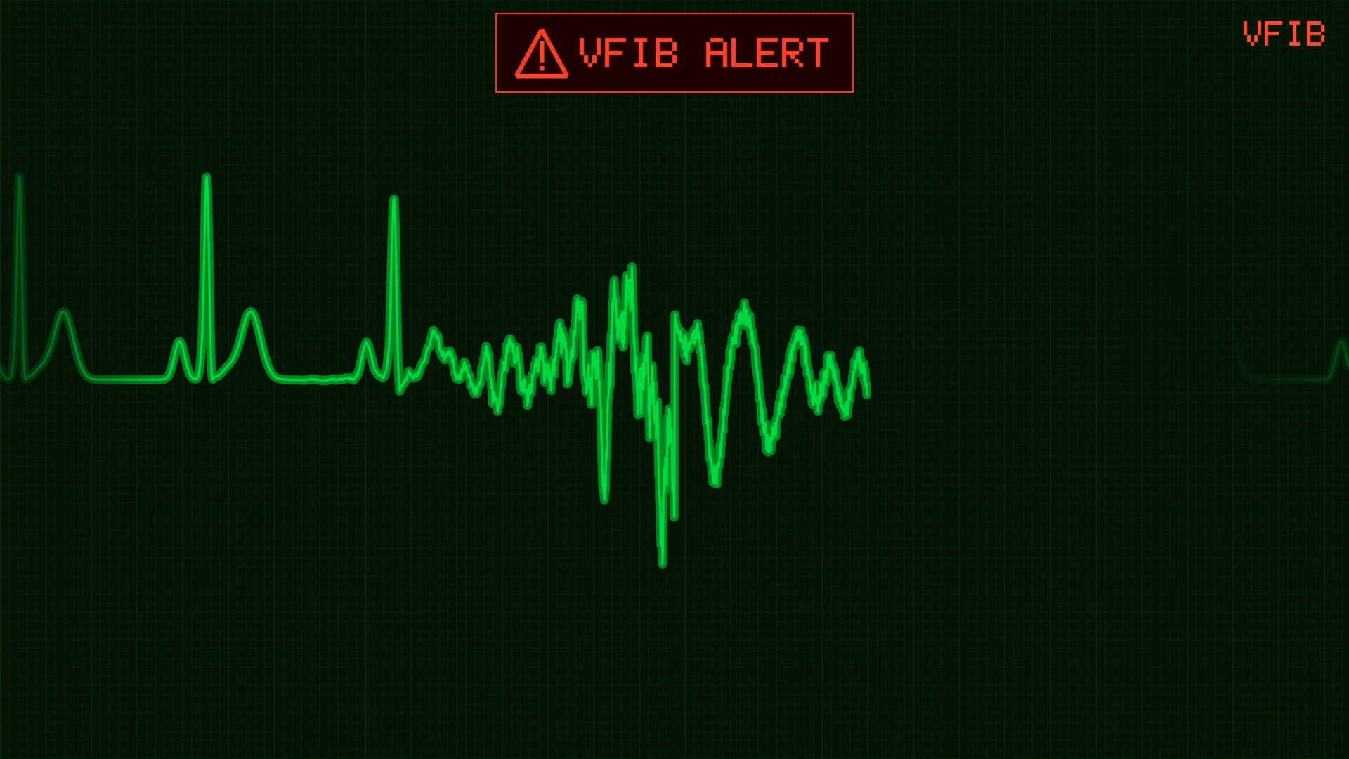 Animated Ekg Heart Rate Monitor Transitions Stock Footage SBV-354742901 ...