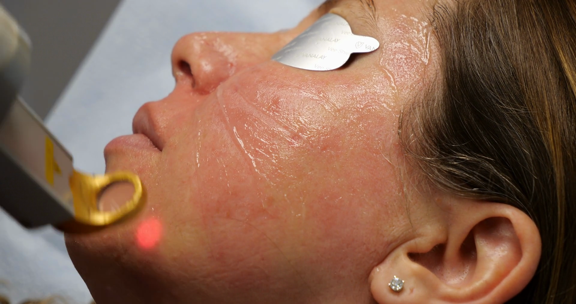 Woman Receiving Ipl Facial Treatment To Stock Footage SBV-349015971 ...