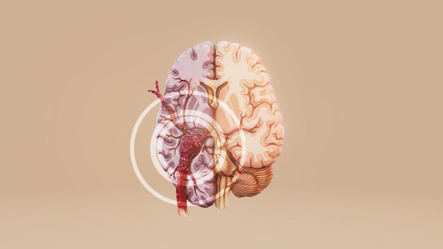 Medical Animation Brain Injury Stock Footage: Royalty-Free Video Clips ...