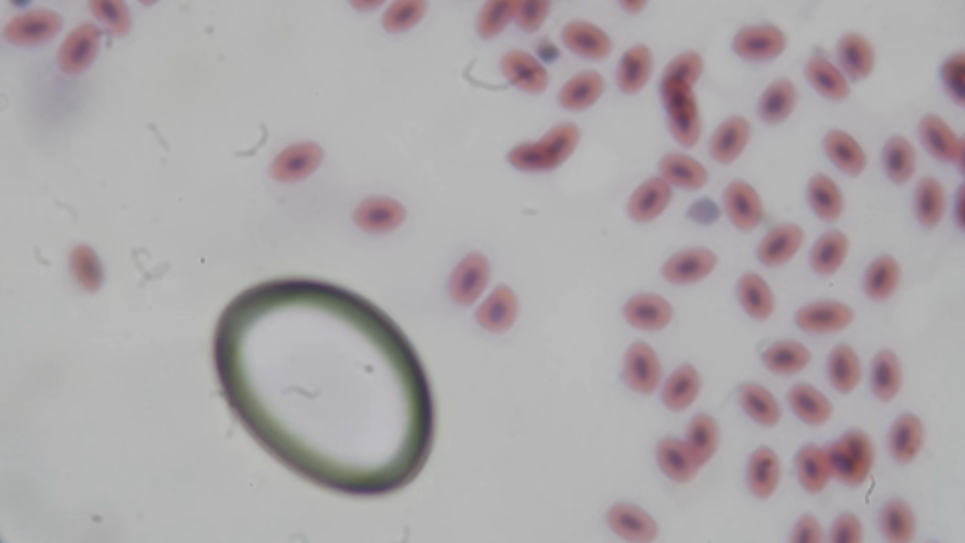 Blood On Microscope Extreme Close Up Stock Footage SBV-353975163 ...