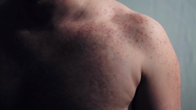 Skin Rashes Stock Footage: Royalty-Free Video Clips - Storyblocks