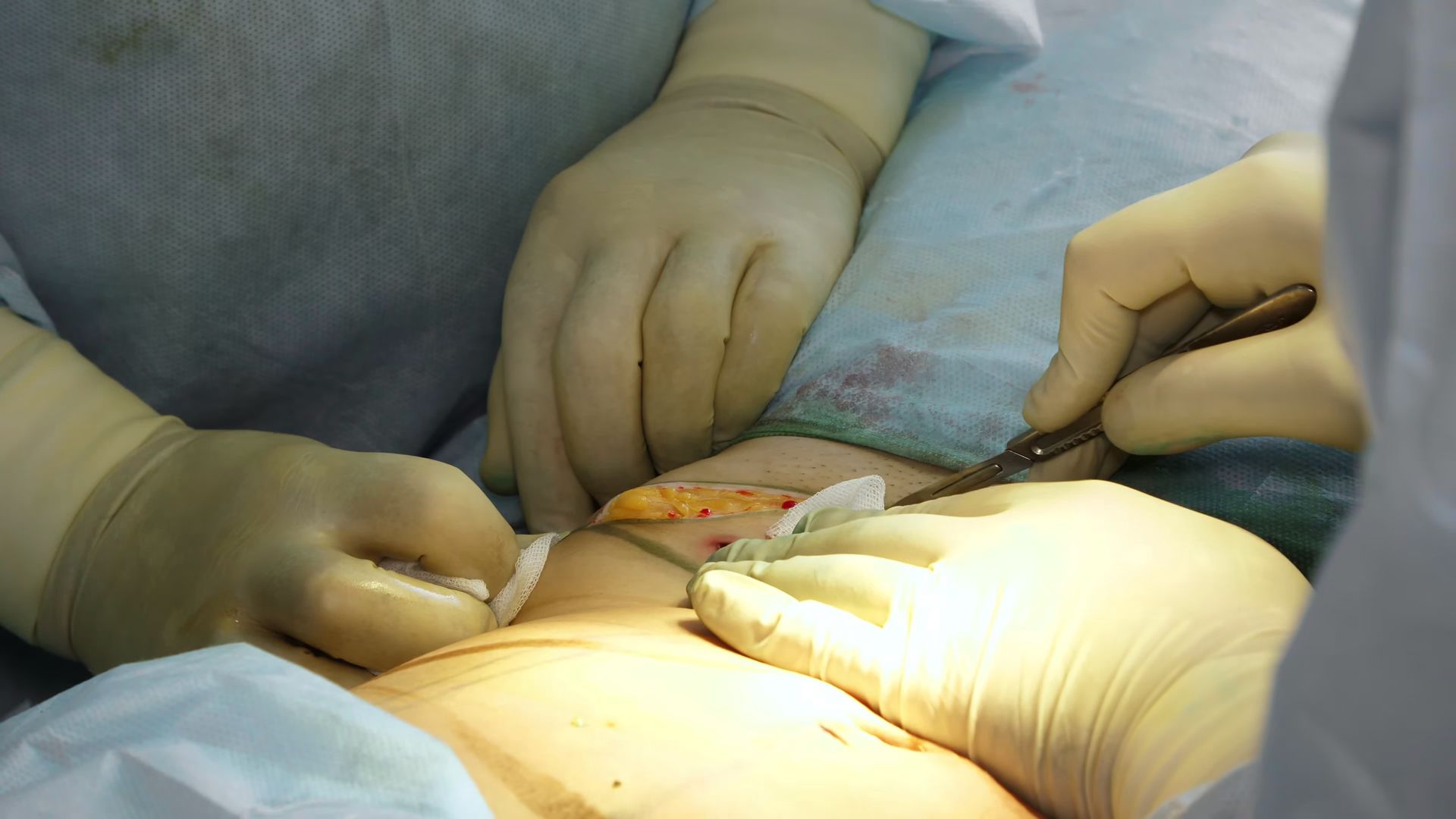Close-up Surgeon Makes Incision On Patient's Stock Footage SBV ...