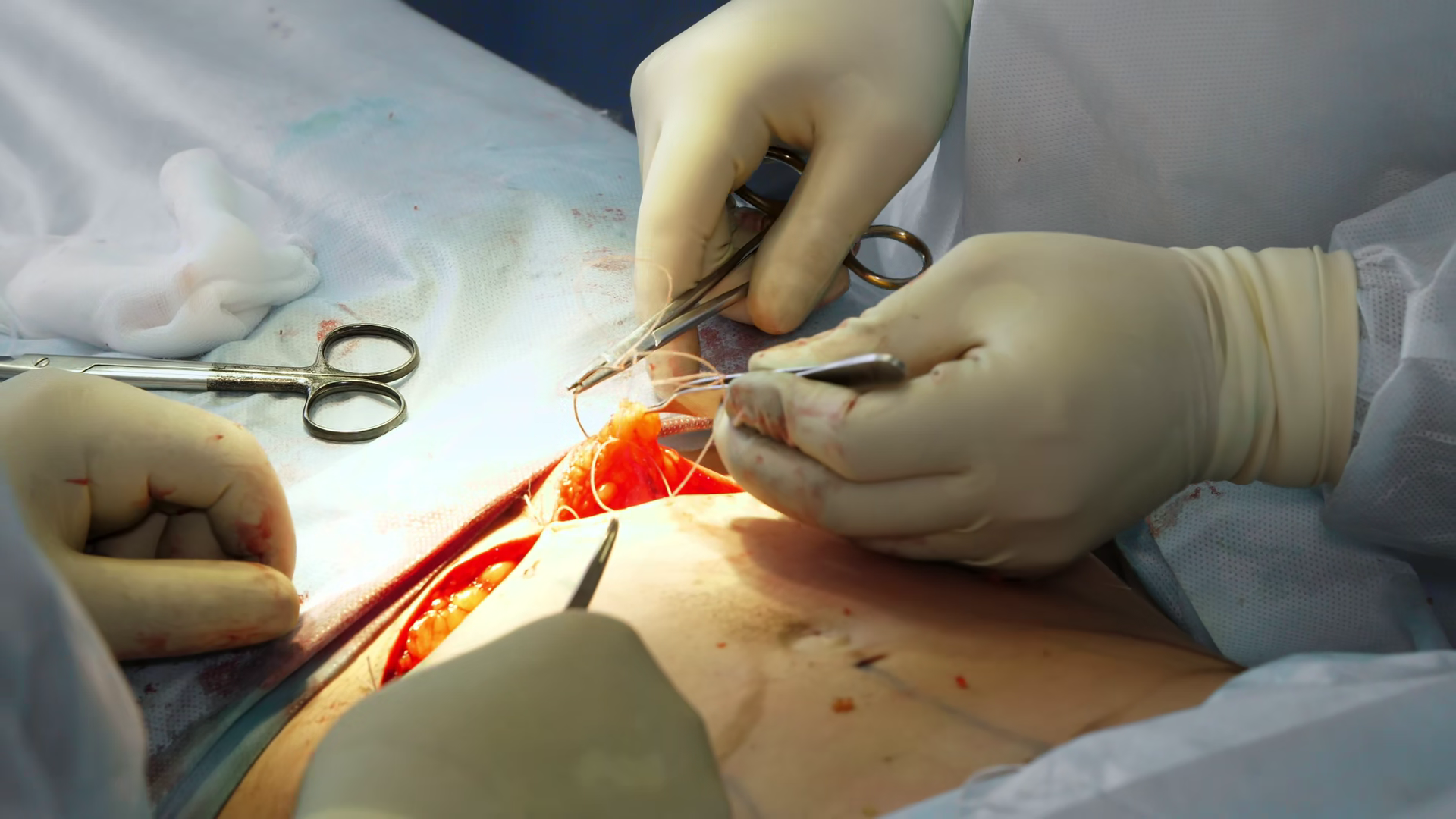Close Up Of Sewing Surgical Incision On Stock Footage SBV-353633136 ...