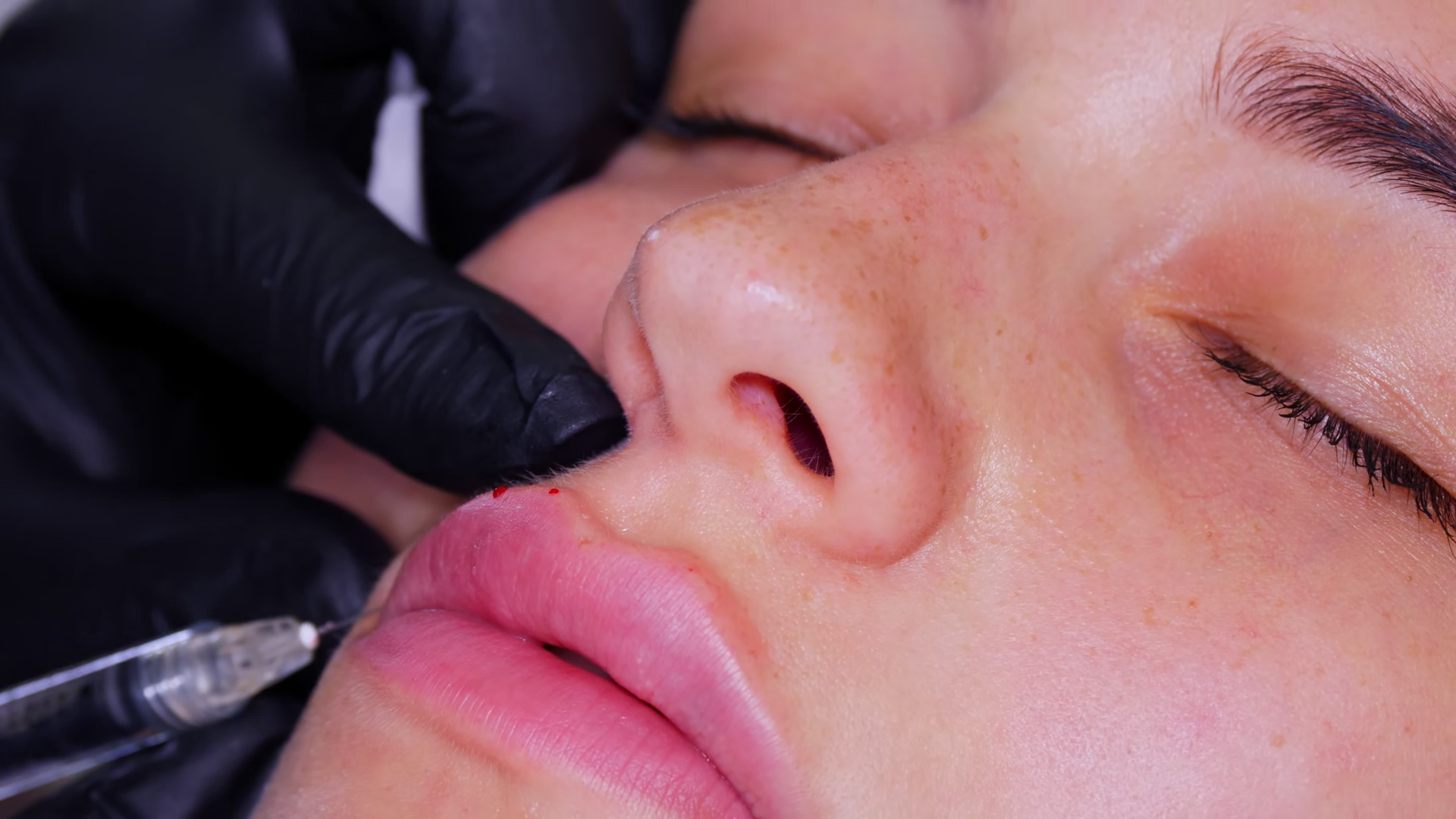 Facial Rejuvenation Process Using Filler Stock Footage SBV-353633762 ...