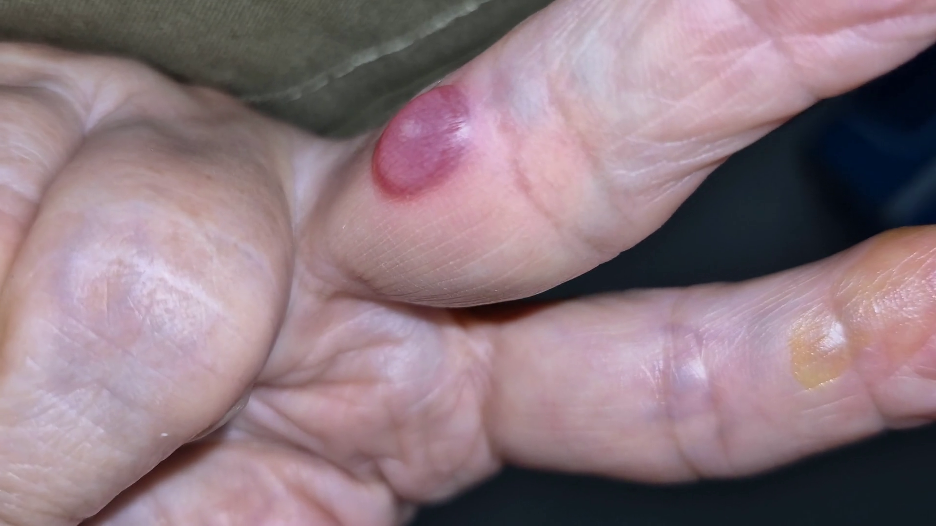 A Close Up Image Of Blood Blister On Side Of Stock Footage SBV ...