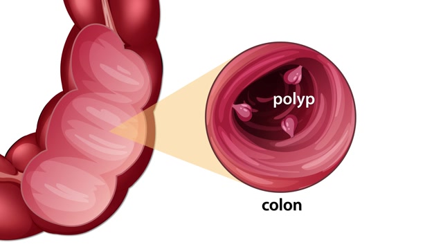 Polyp Stock Footage: Royalty-Free Video Clips - Storyblocks