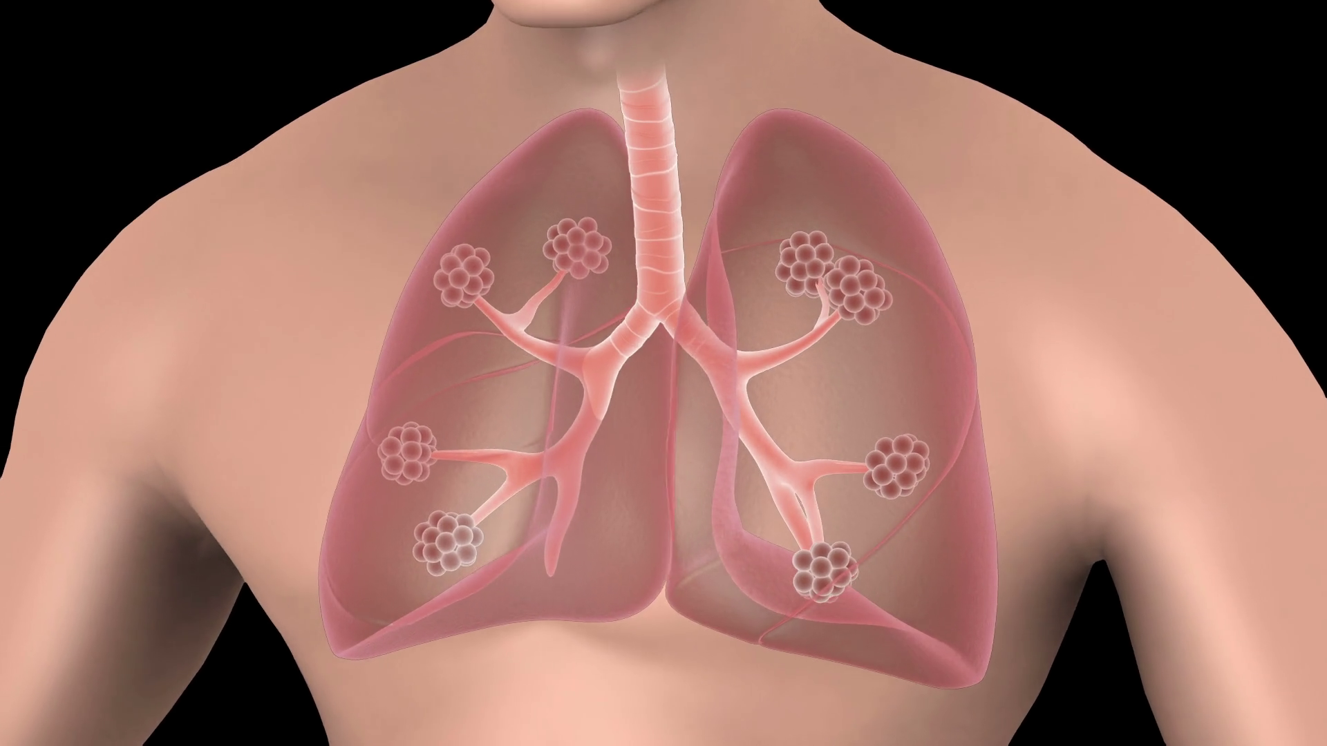Biomedical Animation Of Pneumonia In Human Stock Motion Graphics SBV ...