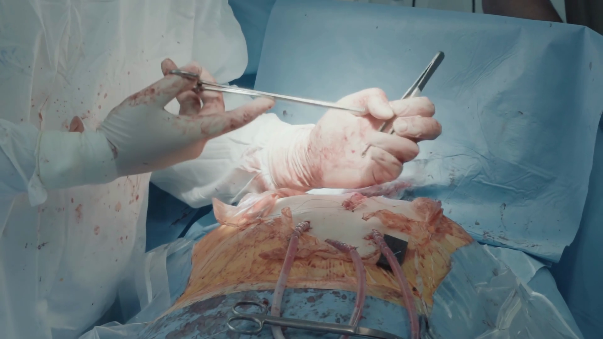 Surgeon In Uniform Closes Incision Focused Stock Footage SBV-349221251 ...