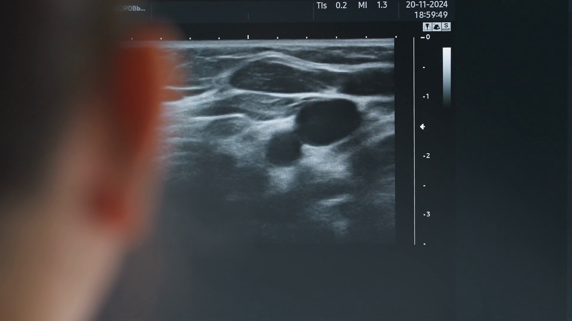 Ultrasound Monitor Showing Detailed Movement Stock Footage SBV ...