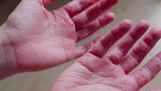 Skin Infections Stock Footage: Royalty-Free Video Clips - Storyblocks