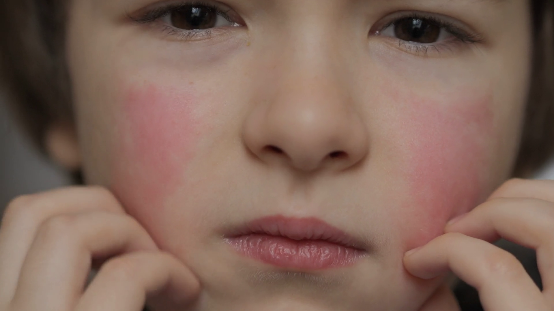 Child Scratching Red Rash On Face Boy Stock Footage SBV-352907834 ...