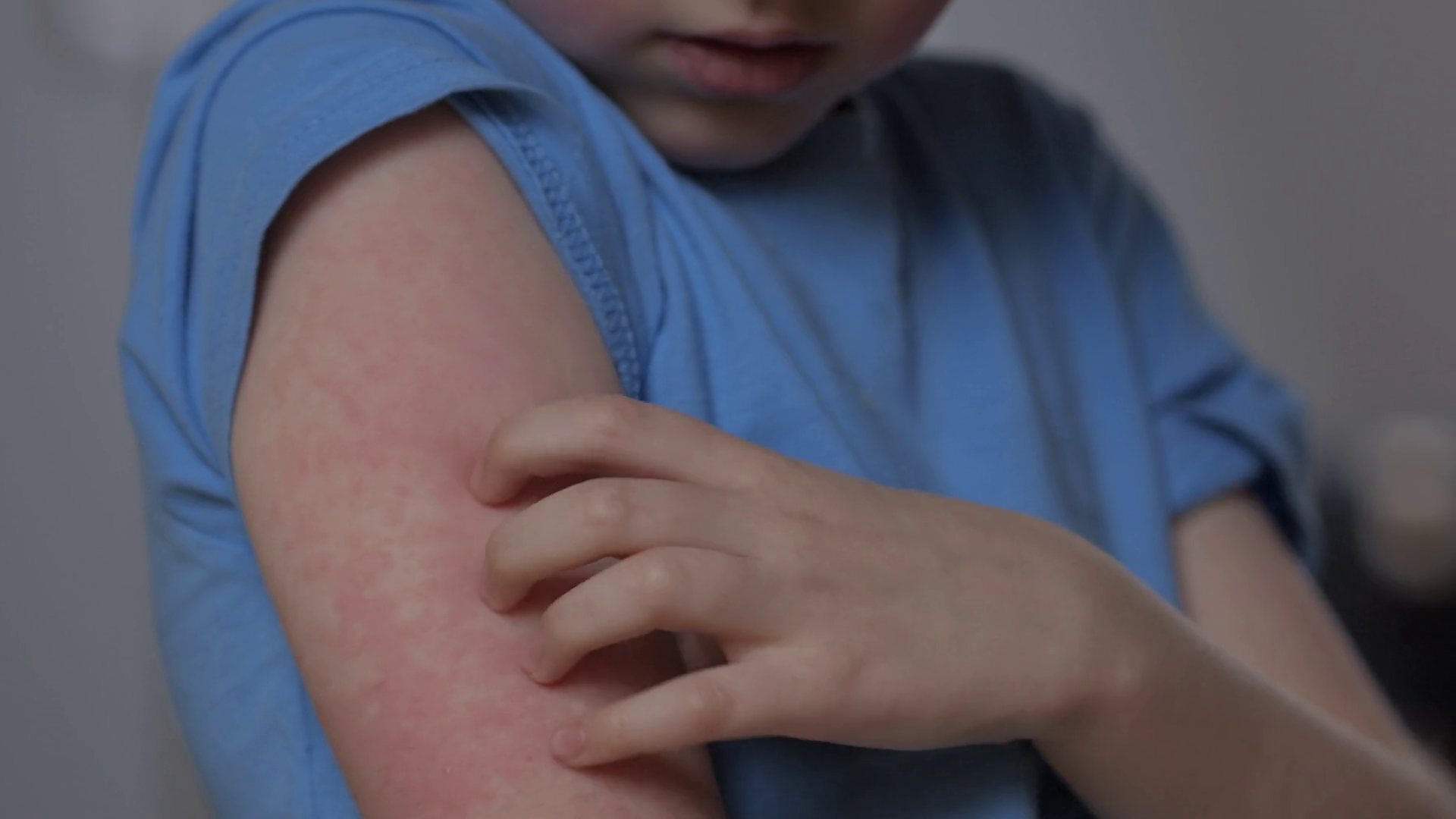 Child Scratching Red Rash On Hand Boy Stock Footage SBV-352907904 ...