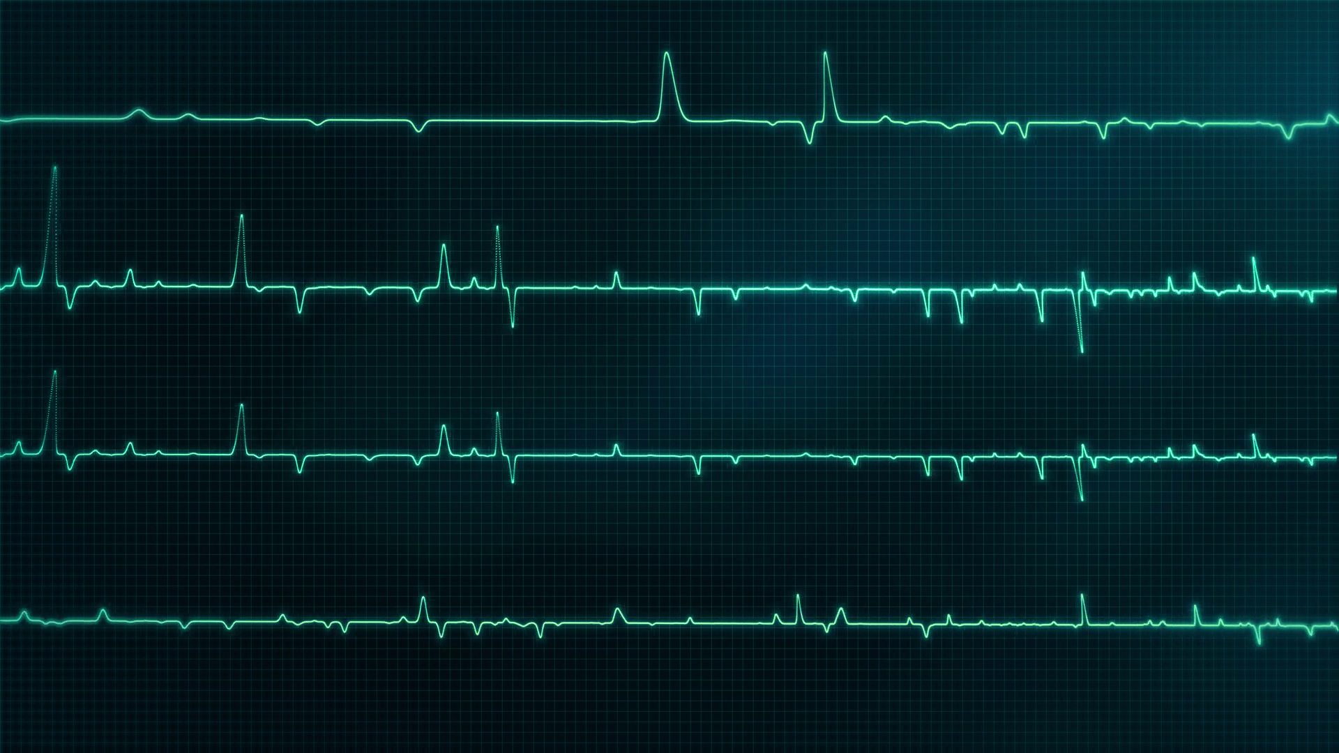 Heartbeat Ecg Monitor Animation Medical Stock Footage SBV-352845082 ...