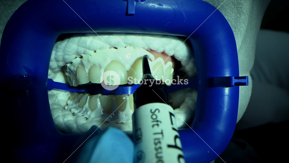 Dental Whitening process in patient mouth. Teeth whitening with UF Lamp, Led Lamp and gel. Dental Extreme Close up Macro Video. Concept of