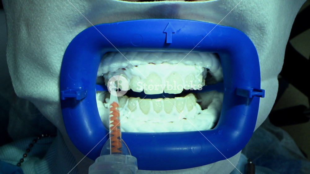 Dental Whitening process in patient mouth. Teeth whitening with UF Lamp, Led Lamp and gel. Dental Extreme Close up Macro Video. Concept of