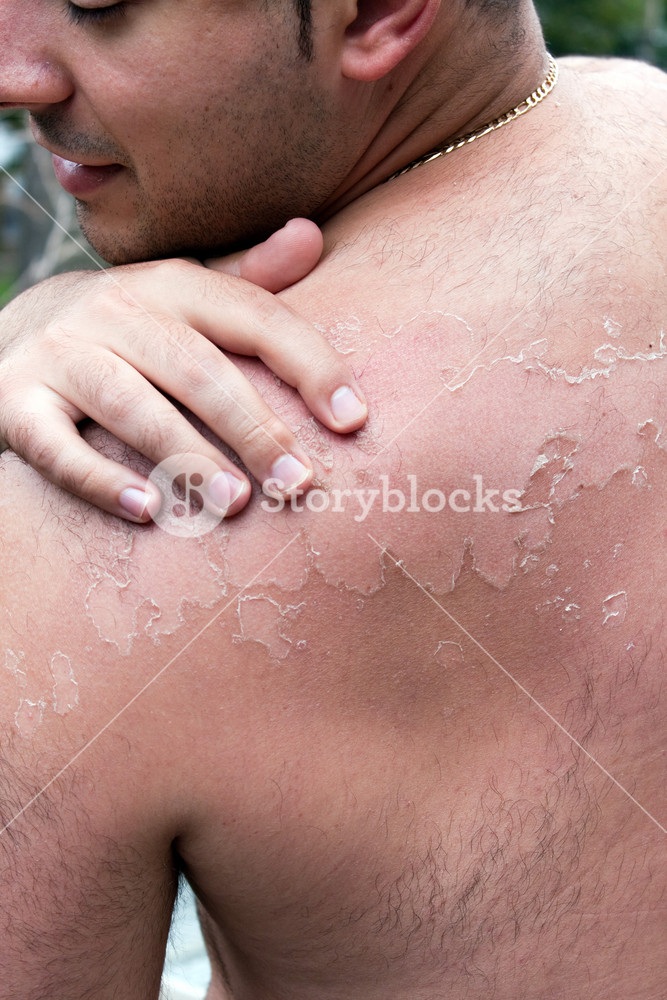 Close up detail of a very bad sunburn showing the peeling blistered skin of a mans back.  Shallow depth of field.