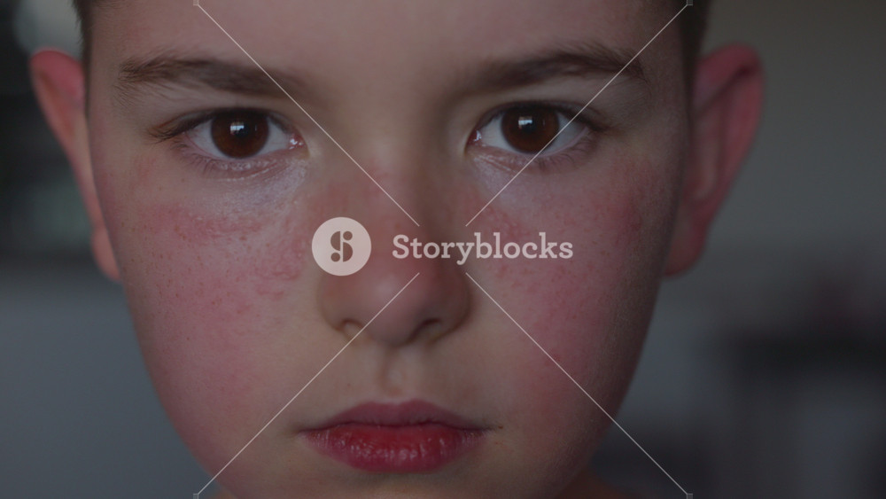 Boy Having Allergic Reaction on Skin to Food. Boy Has Dry Red Skin and Scratching Her Face. Child Scratches Atopic Skin. Dermatitis, Diathesis, Allergy on Child Body and Face. Irritation and Pruritus.